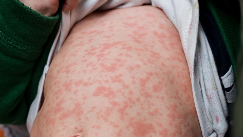 Bệnh sởi chỉ gặp ở trẻ em? Người lớn có cần tiêm vắc xin phòng sởi?