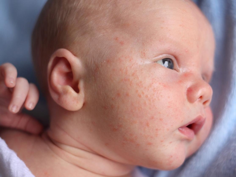 Bệnh sởi có bị lây không 1?