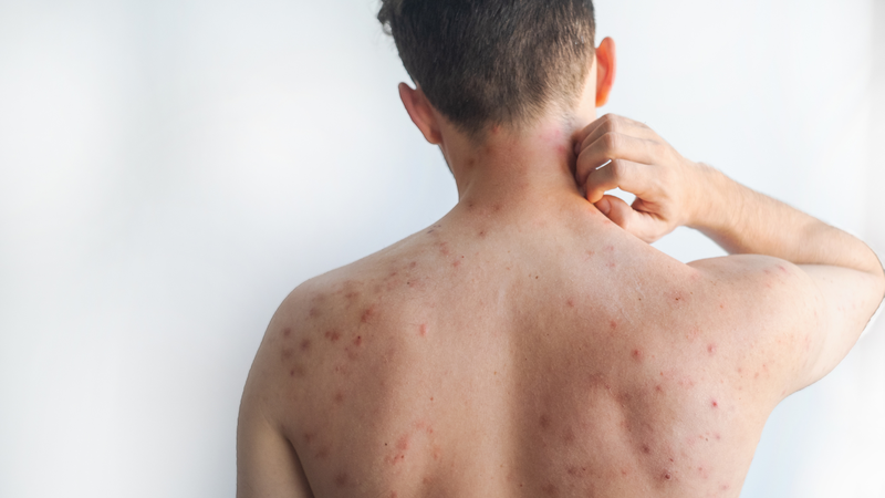 Bệnh sởi có thể lây cho người lớn chưa tiêm vắc xin phòng bệnh