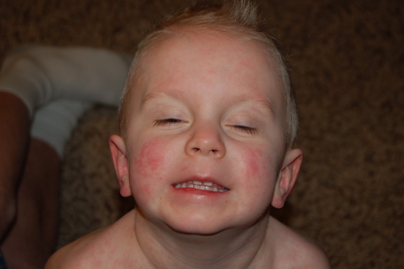 Bệnh sởi có kiêng tắm không 2?