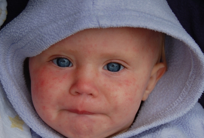 Bệnh sởi có phải là sốt phát ban không 2