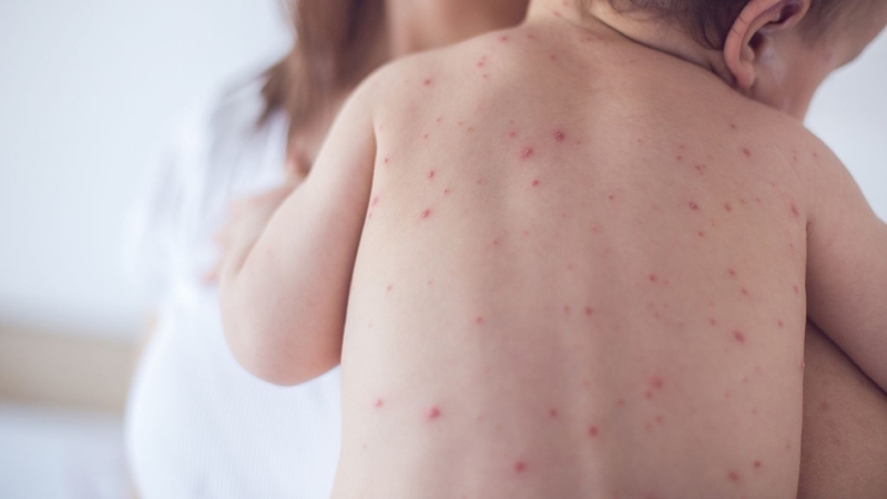 Bệnh sởi lây qua đường nào? Các lưu ý cần biết về bệnh sởi 1