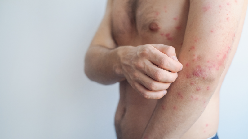 Nguy cơ và biến chứng nguy hiểm khi người lớn mắc sởi