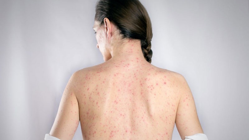 Bệnh sởi ở người lớn và những điều cần lưu ý  1