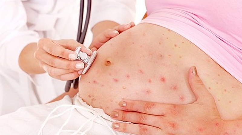 Bệnh sởi ở người lớn và những điều cần lưu ý  2