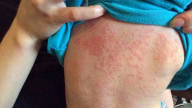 Bệnh sởi ở trẻ em có những dấu hiệu gì? Một số hình ảnh bệnh sởi ở trẻ em thường gặp2