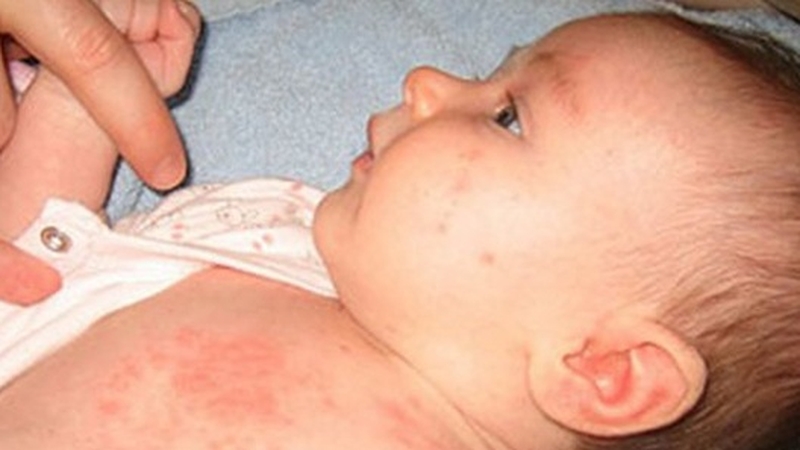 Bệnh sởi ở trẻ sơ sinh có nguy hiểm không? Dấu hiệu và cách phòng ngừa bệnh 2