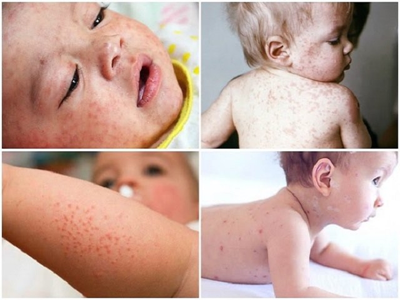 Bệnh sởi ở trẻ sơ sinh có nguy hiểm không?1 Dấu hiệu và cách phòng ngừa bệnh