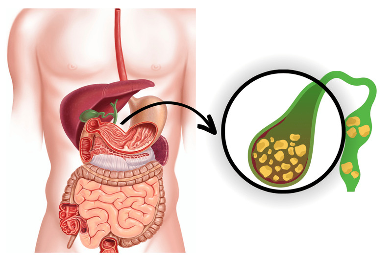 Bệnh sỏi túi mật có nguy hiểm không​?1