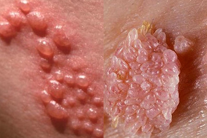 Bệnh sùi mào gà có chữa dứt điểm được không? 3