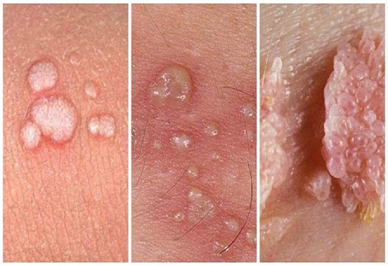 Sùi mào gà còn gọi là bệnh mụn cóc