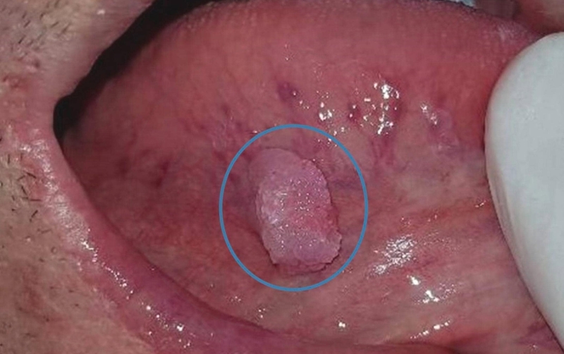 Bệnh sùi mào gà có tự khỏi không? 1