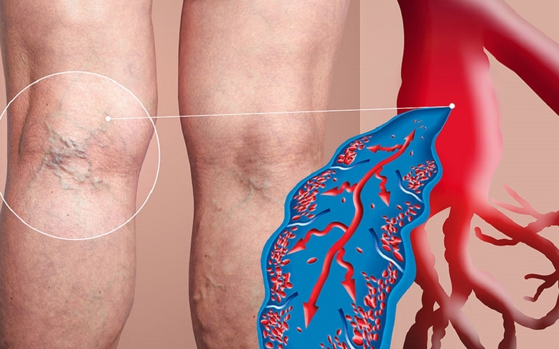 Bệnh suy giãn tĩnh mạch: Nguyên nhân, triệu chứng, cách điều trị 1