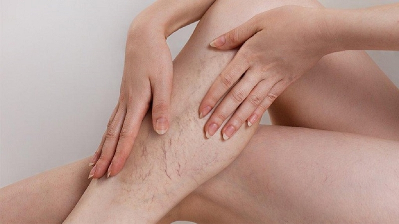 Bệnh suy giãn tĩnh mạch có chữa khỏi được không? Cách chữa bệnh thế nào? 2