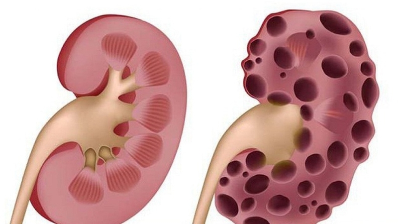 Bệnh suy thận mạn tính có chữa được không? Nguyên nhân và cách điều trị 2