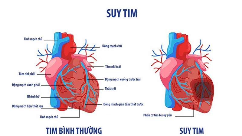 Bệnh suy tim là gì? Bệnh suy tim có chữa được không? 2