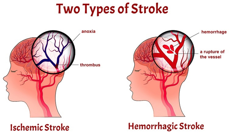 Bệnh tai biến mạch máu não ở người cao tuổi có nguy hiểm không? Nguyên nhân và cách phòng ngừa đột quỵ ở người cao tuổi 2