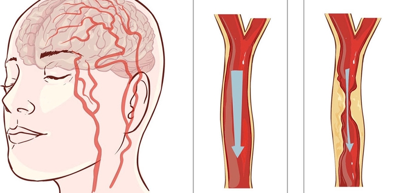 Bệnh tai biến mạch máu não ở người cao tuổi có nguy hiểm không? Nguyên nhân và cách phòng ngừa đột quỵ ở người cao tuổi 2