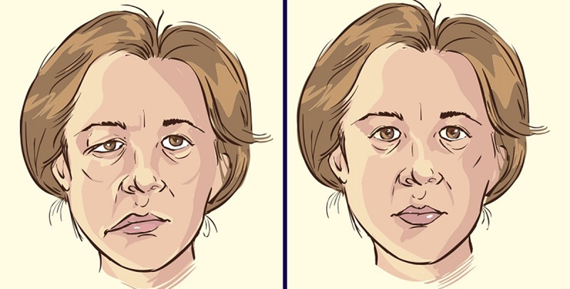 Bệnh tai biến mạch máu não ở người cao tuổi có nguy hiểm không? Nguyên nhân và cách phòng ngừa đột quỵ ở người cao tuổi 3