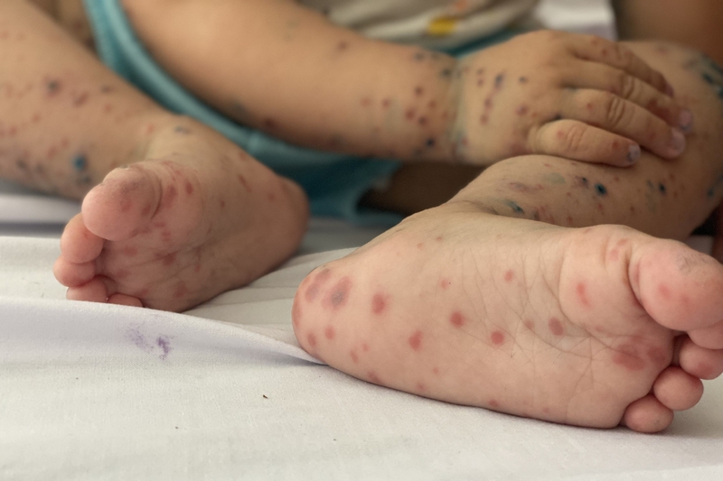 Bệnh tay chân miệng là một bệnh phổ biến ở trẻ dưới 3 tuổi