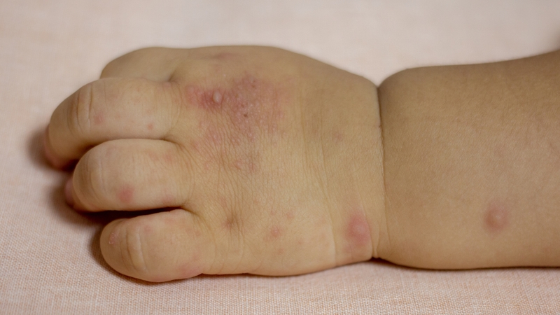 Bệnh tay chân miệng độ 2: Triệu chứng, nguy cơ và cách phòng tránh 1