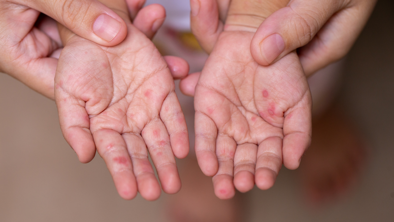 Hiểu rõ bệnh tay chân miệng khi nào hết lây giúp phụ huynh chăm sóc trẻ hiệu quả hơn