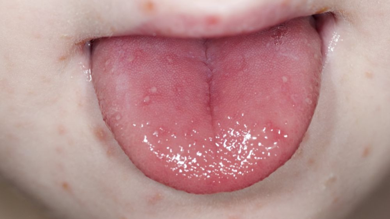 Ban đỏ và loét miệng rõ rệt trong bệnh tay chân miệng ngày thứ 3 khiến trẻ đau rát khó ăn uống