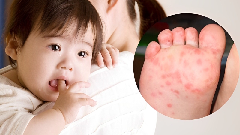 Bệnh tay chân miệng sốt bao nhiêu ngày sẽ khỏi? Cách hạ sốt cho bé bị tay chân miệng 2