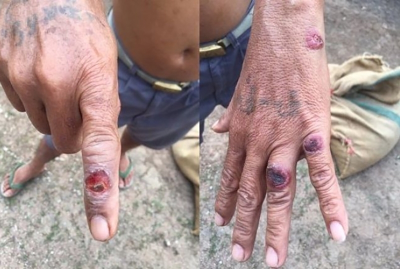 Bệnh than là gì và bệnh than lây nhiễm như thế nào?