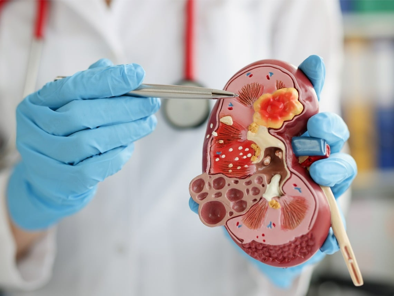 Bệnh thận ứ nước có nguy hiểm không?1