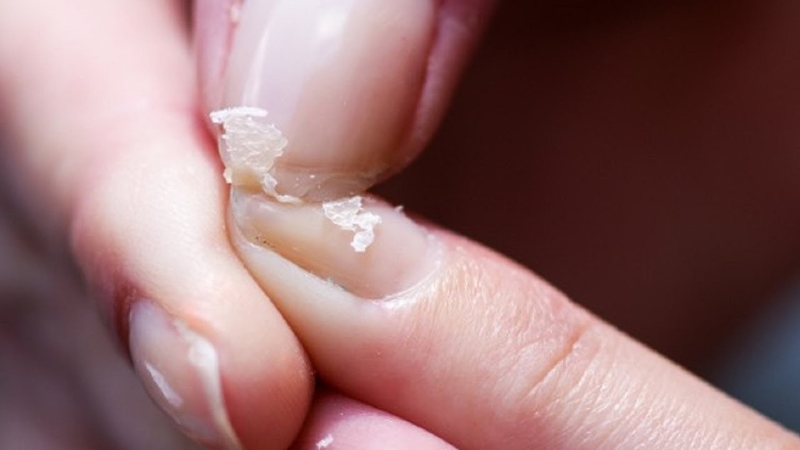 Bệnh thiếu canxi trong xương có triệu chứng như thế nào? 3