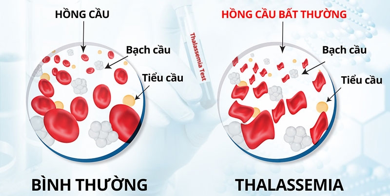 Bệnh thiếu máu hồng cầu nhỏ: Những điều cần biết! 2