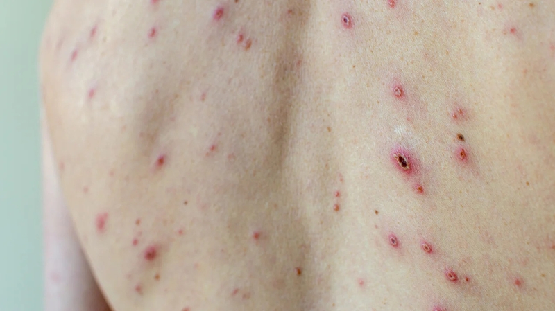 benh-thuy-dau-co-bi-2-lan-khong-cach-phong-ngua-hieu-qua-ban-can-biet 2