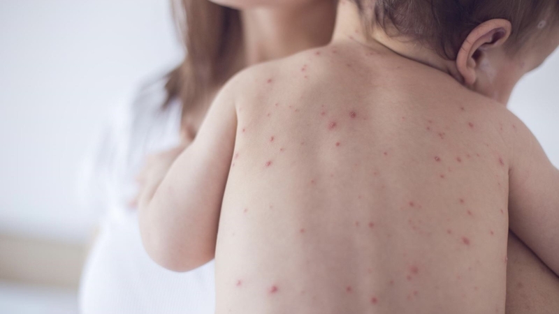 benh-thuy-dau-nang-nam-biet-dau-hieu-bien-chung-va-cach-phong-ngua 4