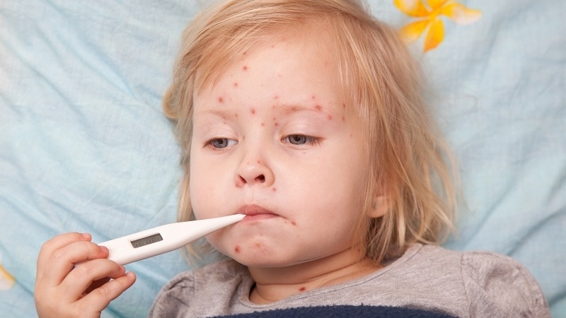 dấu hiệu nhận biết trẻ mắc thủy đậu 2