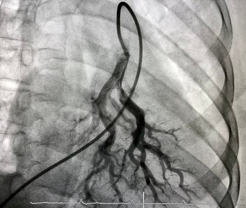 Chụp động mạch phổi là kỹ thuật chính xác nhất để chẩn đoán bệnh thuyên tắc phổi cấp