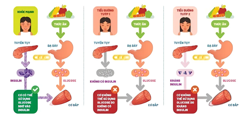 Bệnh tiểu đường tuýp 2 ở người trẻ có thể là một dạng rối loạn đặc biệt về mặt di truyền 1