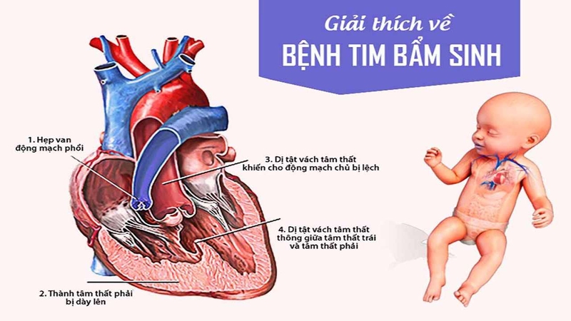 Bệnh tim bẩm sinh ở trẻ em là dạng dị tật của tim