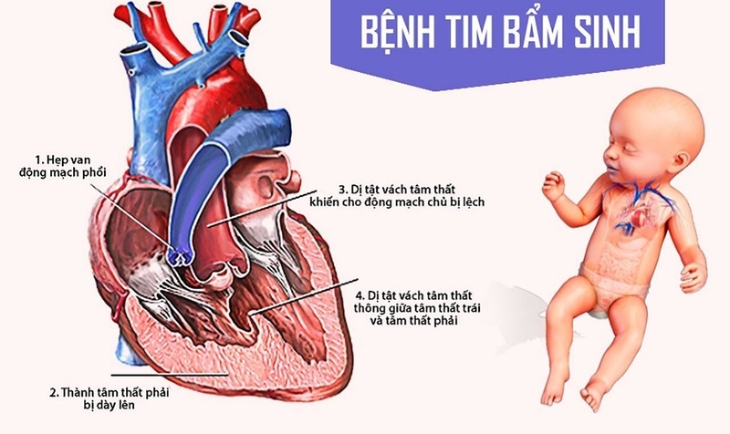 bệnh tim bẩm sinh sống được bao lâu