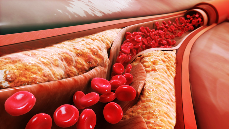 Bệnh tim mạch - “kẻ giết người số 1 thế giới” ngày càng trẻ hóa 1