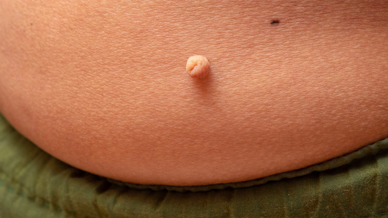 Bệnh to các viễn cực là gì? Nguyên nhân, triệu chứng và cách điều trị 4