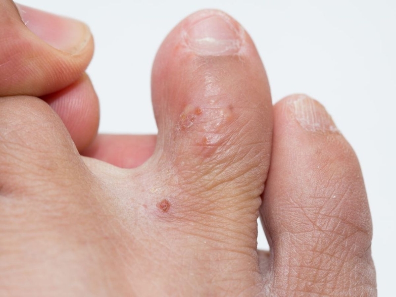 Bệnh tổ đỉa chân: Nguyên nhân và cách phòng tránh 1