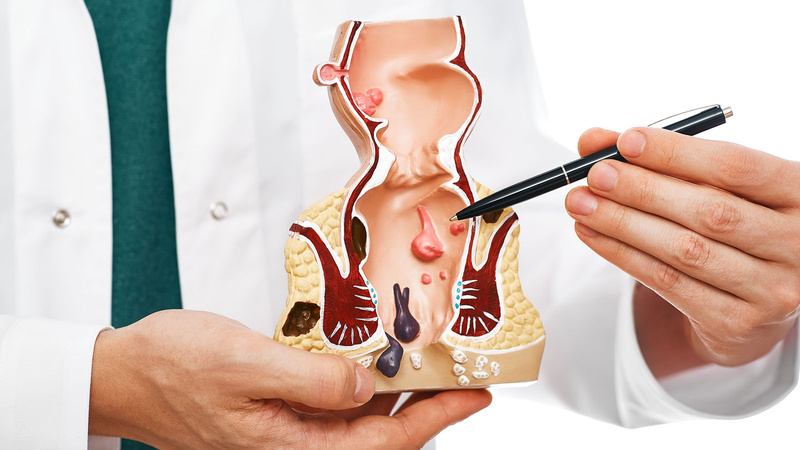 Bệnh trĩ có lây khi ngồi chung ghế không? Làm thế nào để phòng ngừa bệnh trĩ1