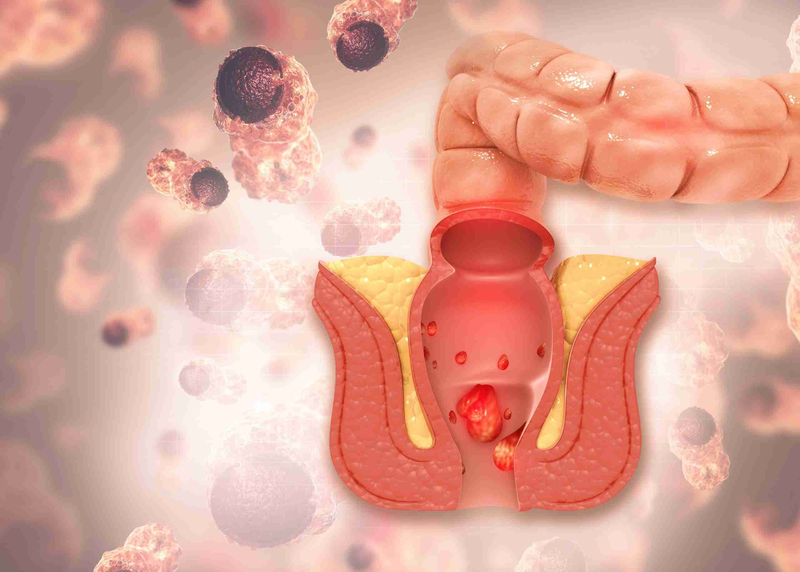 Bệnh trĩ có lây khi ngồi chung ghế không? Làm thế nào để phòng ngừa bệnh trĩ2