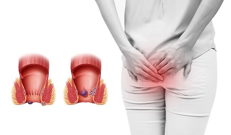 Bệnh trĩ gây nên khị các tĩnh mạch ở vùng hậu môn bị tổn thương