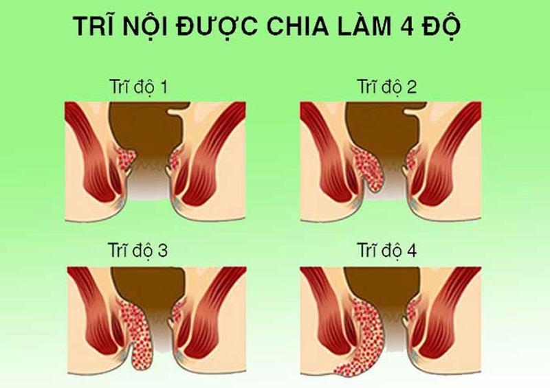 Bệnh trĩ là gì? 3 cách chữa trĩ hiệu quả tại nhà 1