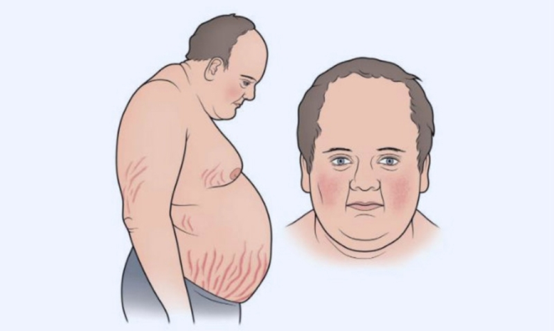 Bệnh u tuyến yên sống được bao lâu? Những điều cần biết về căn bệnh u tuyến yên 2