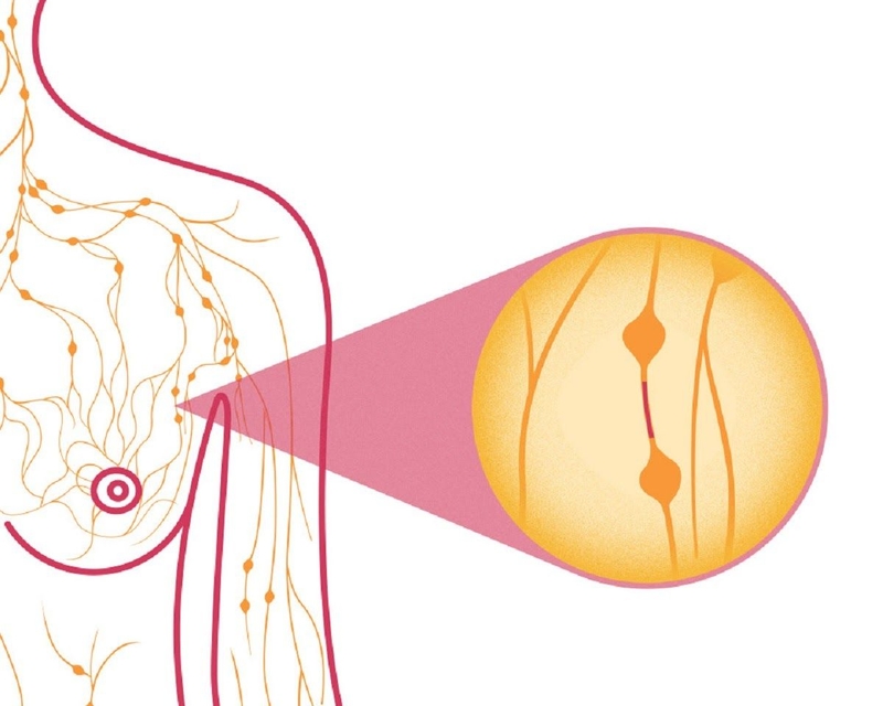 Ung thư vú dạng viêm: Dấu hiệu và phương pháp điều trị 1