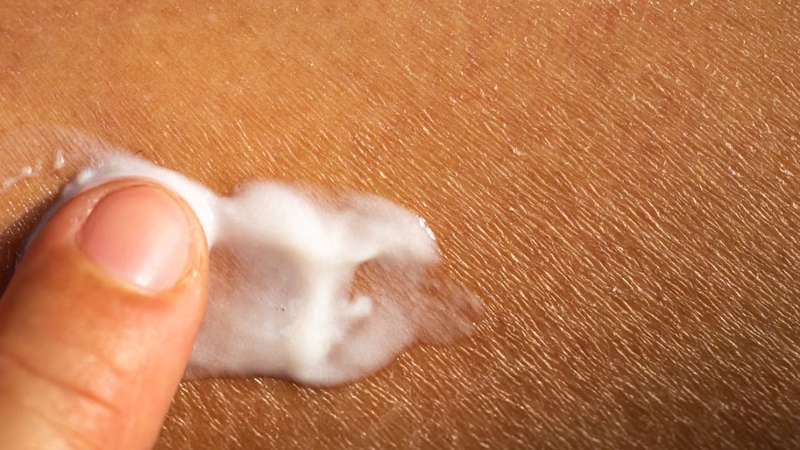 Bệnh vảy cá có lây không? Nguyên nhân và cách điều trị bệnh vảy cá 4