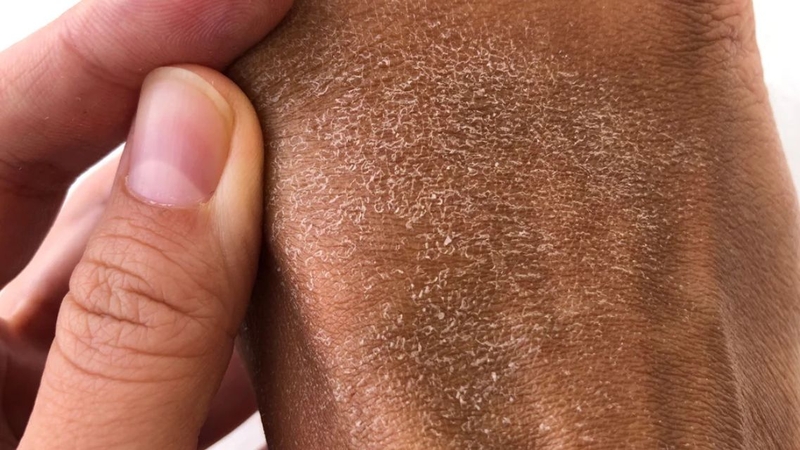 Bệnh vảy cá có lây không? Nguyên nhân và cách điều trị bệnh vảy cá 2